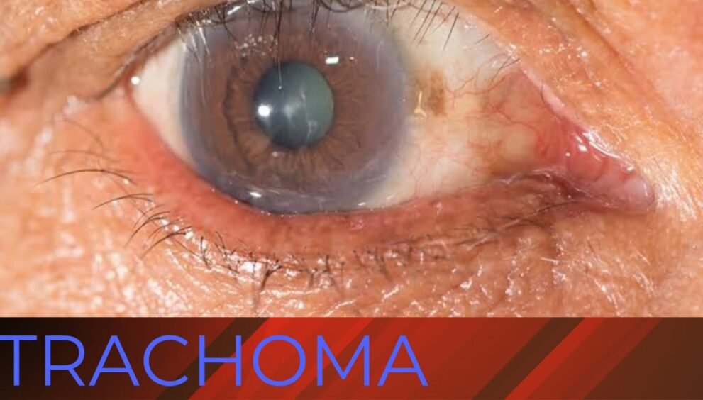 Trachoma eye