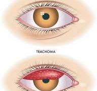 Trachoma Disease